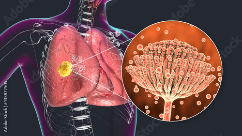 Pulmonary aspergillosis, invasion of a lung tissue by mold fungi Aspergillus with closeup view of the fungi, 3D illustration photo