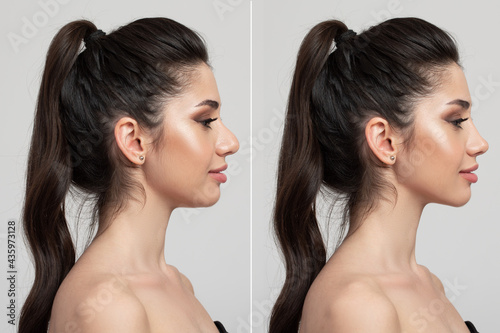 Photos chin, face and nose lift before after photo