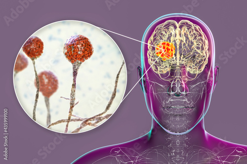 Brain mucormycosis, a brain lesion caused by fungi Mucor, also known as black fungus, with close-up view of the fungi, 3D illustration photo