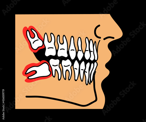 Wisdom teeth in the mouth. Cartoon. Vector illustration.
