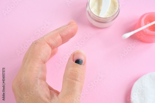 Injured finger on the hand with a hematoma under the nail on pink background with ointment and cotton pads. Household trauma  finger treatment after impact