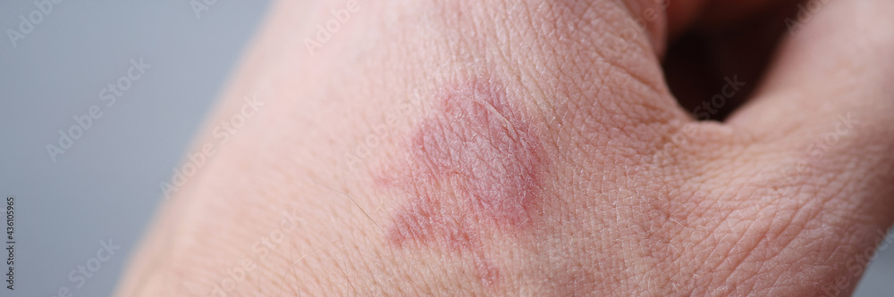 Closeup of burn stain on mans hand Closeup of burn stain on mans hand