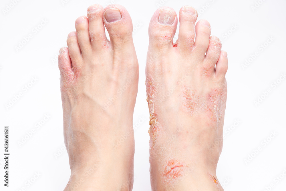Wound on human barefoot and copy space. Medical concept. Wound on human barefoot and copy space. Medical concept.