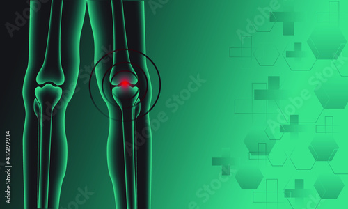 Illustration of Arthritis  joint . Rheumatoid arthritis. Pain in leg. Human bone anatomy flat vector illustration. Painful injury erosion on a green technology background.