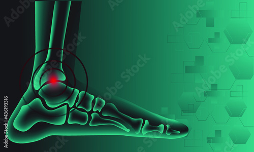 Illustration of Arthritis  ankle joint . Rheumatoid arthritis. Pain in leg. Human bone anatomy flat vector illustration. Painful injury erosion on a green technology background.