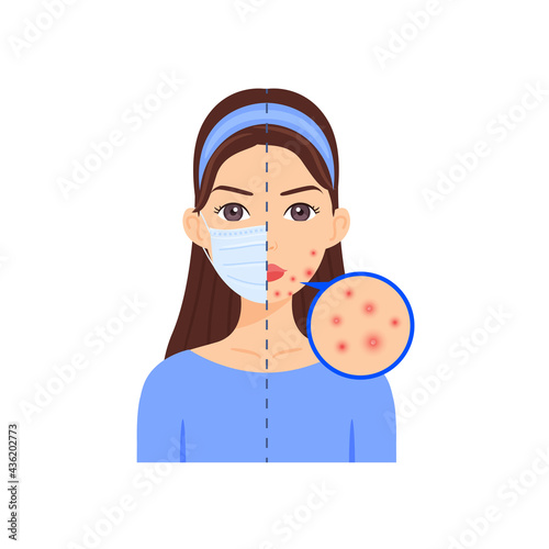 Attractive Girl in a Medical Mask. Pimples on a Beautiful Face from wearing a medical mask. Problem Skin. Flat color cartoon fashion style. White background. Vector stock illustration.