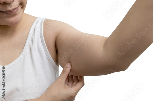 Concept of cosmetic surgery for removing excess fat and cellulite from under the skin,young female is touching her large arms,showing the sagging layer of fat from her upper arm from shoulder to elbow photo