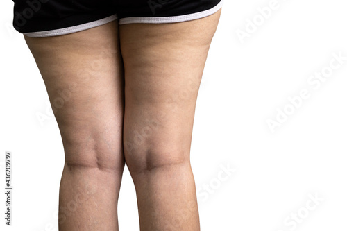 Foto Female standing and showing the excess weight of cellulite from under the flabby