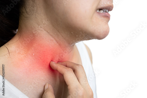 Quadro su tela Asian woman scratching an itchy area that is sweating from hot weather,an allerg