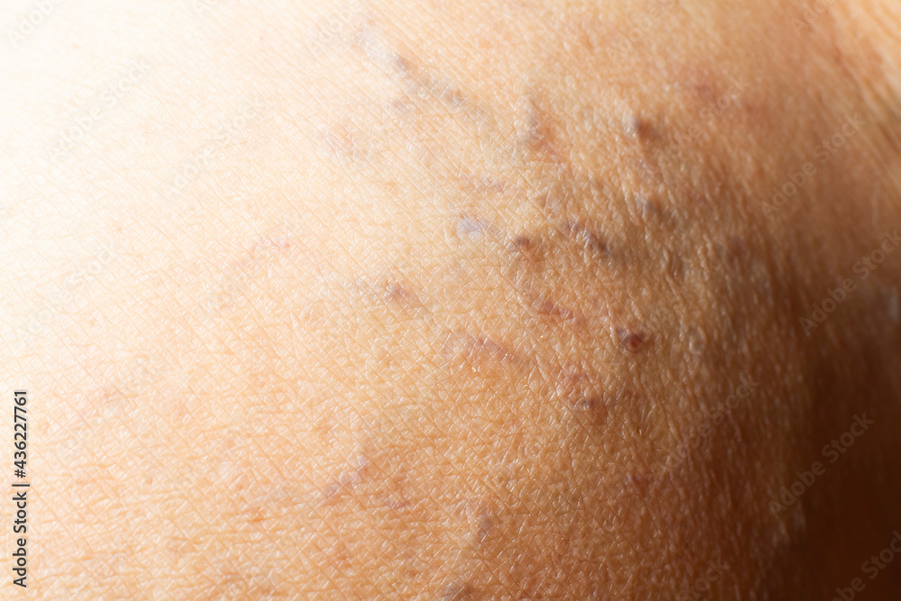 Fototapeta premium Varicose veins on a leg in Senior women, Close up & Macro shot, Selective focus, Asian body skin part, Healthcare concept