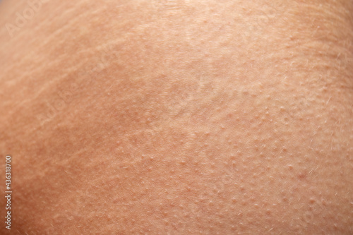 Stretch marks of butt skin. Female buttocks with stretching marks