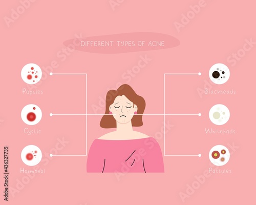 Different types of acne infographic illustration