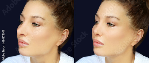 Rhinoplasty,septoplasty. Before and after correction