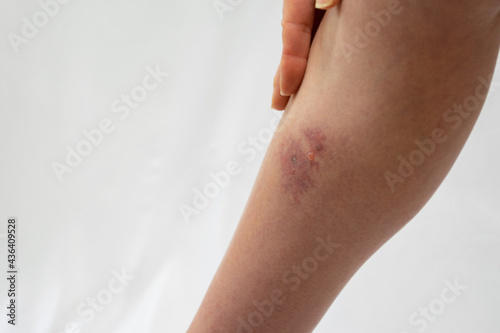 蜂窩織炎（蜂巣炎）の症状が出ている足のふくらはぎ内側