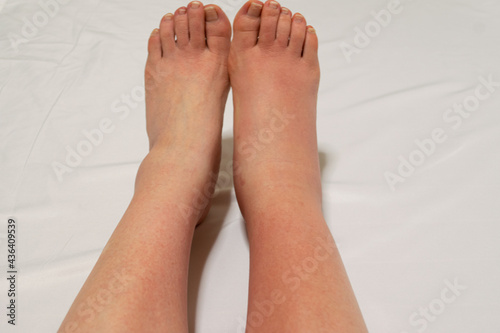 足の甲からふくらはぎにかけて現れた蜂窩織炎（蜂巣炎）の初期症状