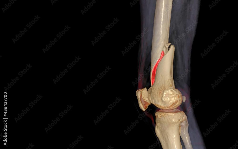 CT knee 3D rendering image Lateral view isolated on black background showing fracture Femur bone. CT knee 3D rendering image Lateral view isolated on black background showing fracture Femur bone.