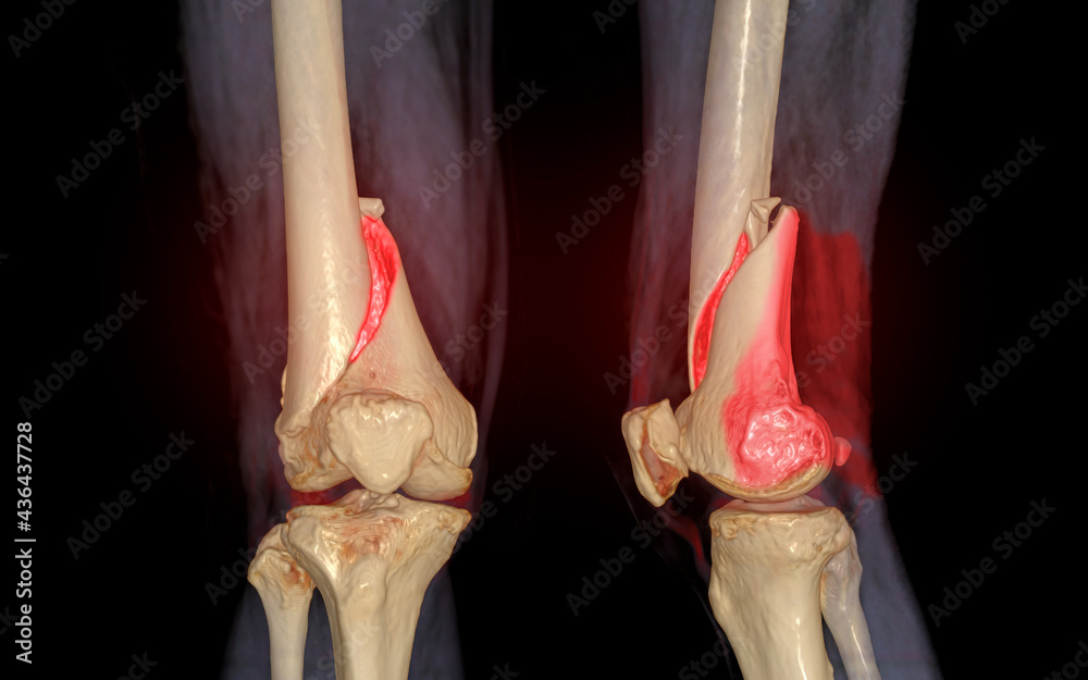 CT knee 3D rendering image AP and Lateral view isolated on black ...