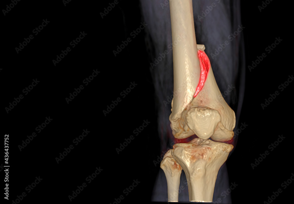 CT knee 3D rendering image AP view isolated on black background showing ...
