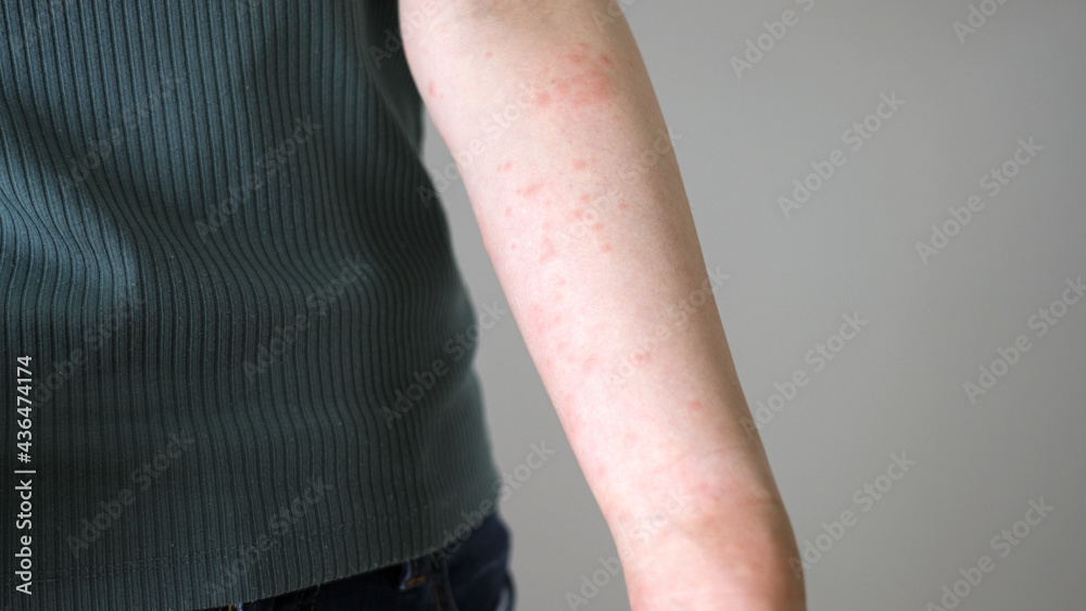 ストレスで腕に湿疹が出る女性 Stock Photo | Adobe Stock