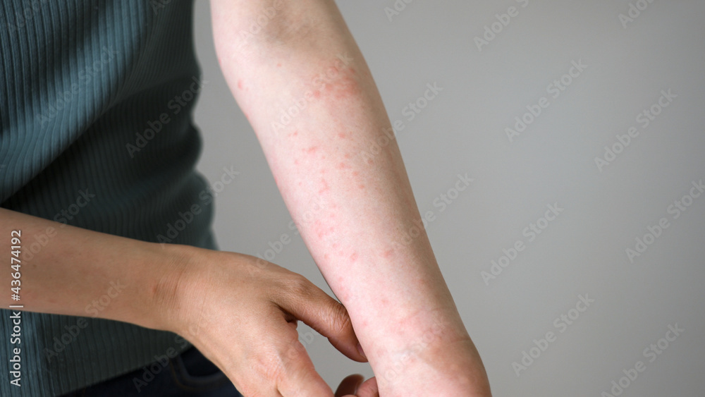 ストレスで腕に湿疹が出る女性 Stock 写真 | Adobe Stock