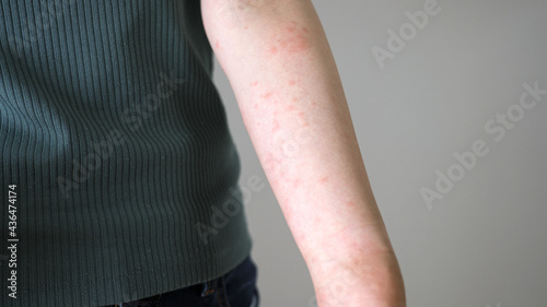 ストレスで腕に湿疹が出る女性 © polkadot
