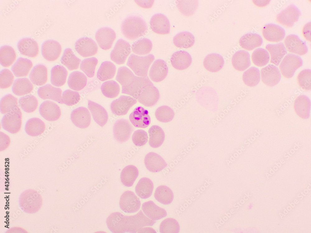 Malaria parasite in red blood cells, ring form stage of Plasmodium falciparum, original magnification 1000x