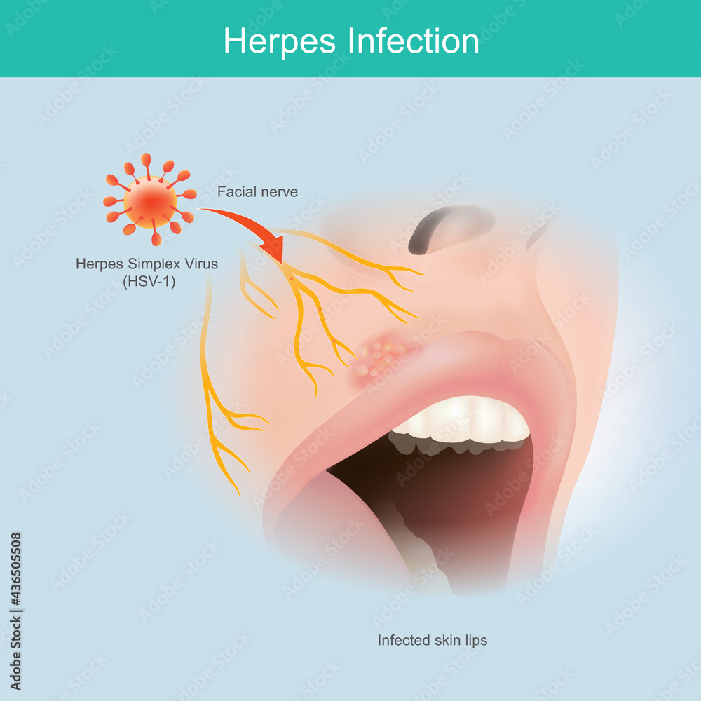 Herpes Infection. Illustration human facial nerve skin for use explain herpes simplex virus lip