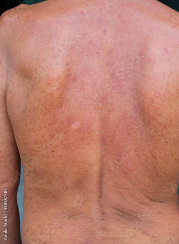 The skin of a person with a rash