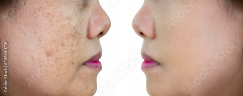 Image before and after dark spot wrinkle melasma pigmentation skin facial treatment on face asian woman.Problem skincare and beauty concept. 