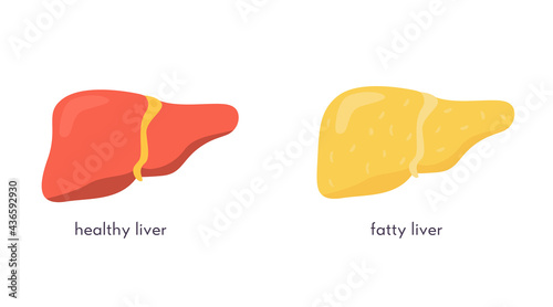 Stages of nonalcoholic liver damage. Healthy and unhealthy fatty human organ. Liver Disease. Vector illustration in flat cartoon style isolated on white.