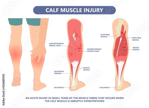 Calf Pain leg back muscle blood vessels nerve acute sport damage arterial trauma tennis soccer tear Cramp spasm Charley horses medial fiber bruising run walk tendon Clot deep vein pull torn up sprain