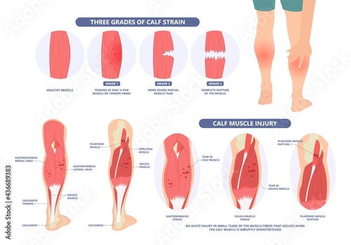 Calf Pain leg back muscle blood vessels nerve acute sport damage arterial trauma tennis soccer tear Cramp spasm Charley horses medial fiber bruising run walk tendon Clot deep vein pull torn up sprain