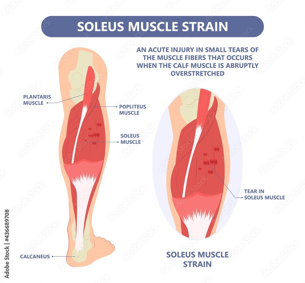 Calf Pain leg back muscle blood vessels nerve acute sport damage