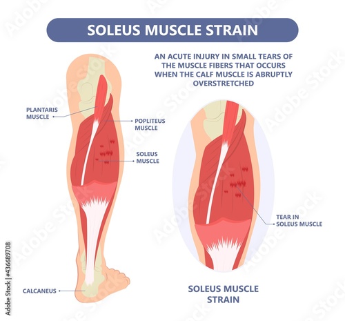 Calf Pain leg back muscle blood vessels nerve acute sport damage arterial trauma tennis soccer tear Cramp spasm Charley horses medial fiber bruising run walk tendon Clot deep vein pull torn up sprain