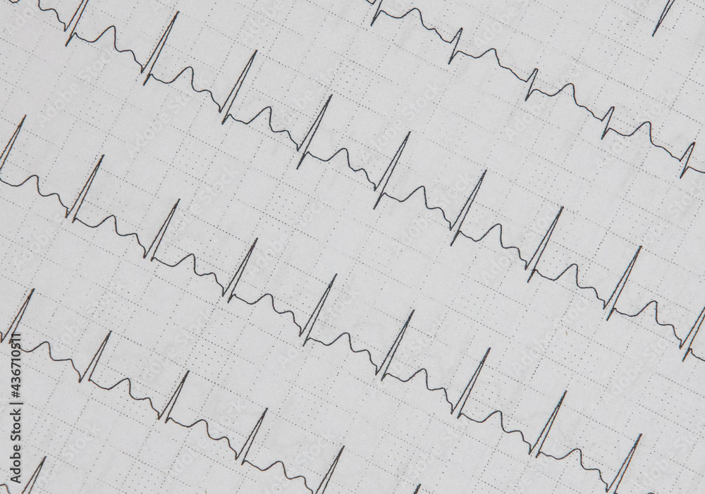 a cardiac EKG printed on paper