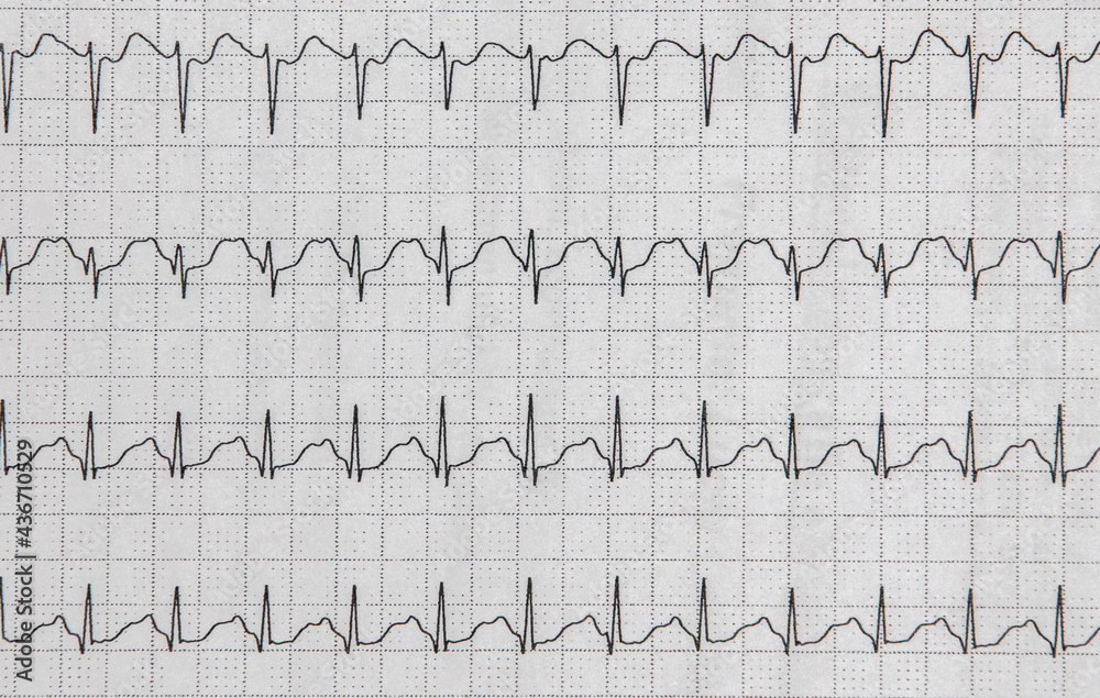 ecg graph on a paper