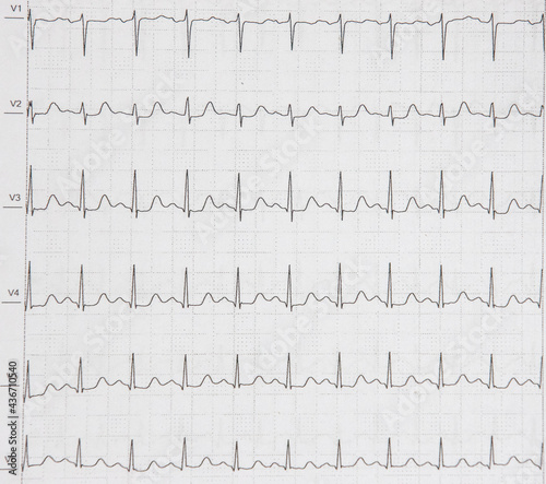 a cardiac EKG printed on paper