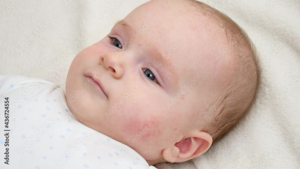 Portrait of cute little baby with red skin suffering from acne or dermatitis. Concept of newborn baby hygiene, health and skin care Portrait of cute little baby with red skin suffering from acne or dermatitis. Concept of newborn baby hygiene, health and skin care