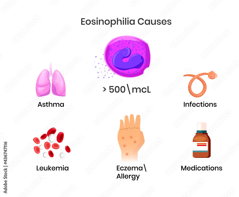 Causes of the eosinophilia. Diagram showing most popular disorders
