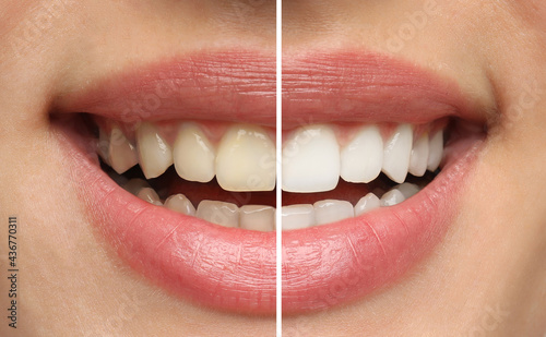 Collage with photos of woman before and after teeth whitening, closeup