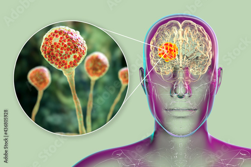 Brain mucormycosis, a brain lesion caused by fungi Mucor, also known as black fungus, with close-up view of the fungi, 3D illustration photo