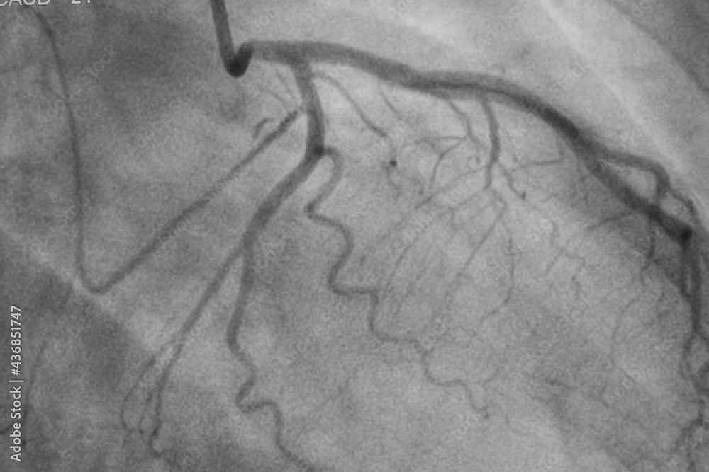 Coronary angiography, Coronary artery disease. Medical xray of heart