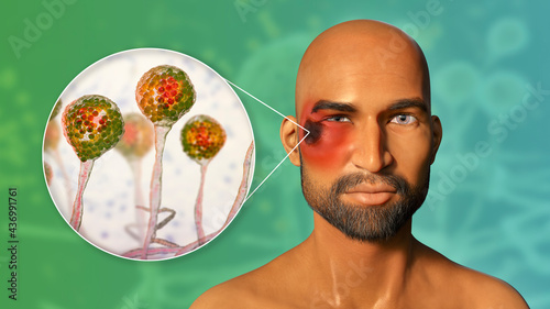 Periorbital cutaneous mucormycosis, a disease caused by Mucor fungi photo