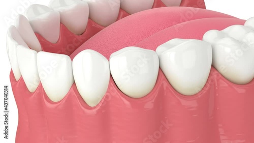 Lower jaw with gums recession process