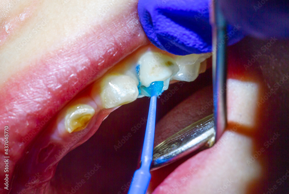 Treatment of baby teeth in a child, dental drill, installation and