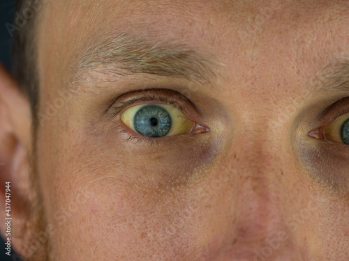 Mens eyes obstructive Jaundice yellowish. Real people liver dysfunction icteruswith cirrhosis hepatitis symptom face skin. Young man bilirubin pigmentation biliary tract obstruction Gilbert's syndrome