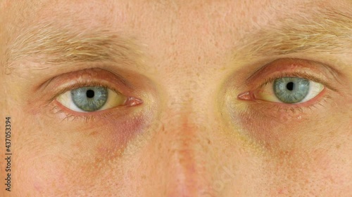 Mens eyes obstructive Jaundice yellowish. Real people liver dysfunction icteruswith cirrhosis hepatitis symptom face skin. Young man bilirubin pigmentation biliary tract obstruction Gilbert's syndrome photo