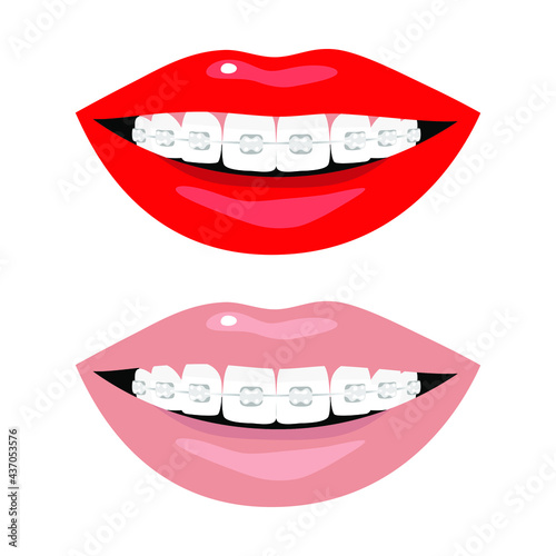 Dental braces, bright red and natural beige female lips, smile. Teeth, dentistry, orthodontics, medicine, health, beauty, aesthetics. Set of vector isolated illustrations on white background