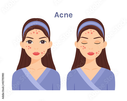 Isolated Beautiful Brunette Woman with Acne. Facial Skin Problems.Girl with open eyes and closed.White background. Color fashion flat illustration.Vector stock illustration.