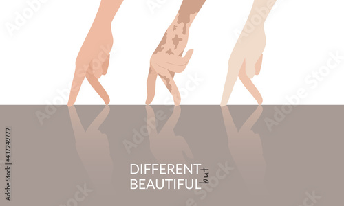 The hands of a normal, vitiligo, albino move together over the surface and are reflected on it. Vector graphics for World Vitiligo Day and International Albinism Awareness Day. Flat design.